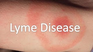 Lyme Disease Care Minnesota Minnesota