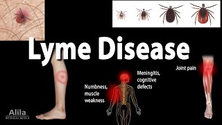 Lyme Disease Clinic California California