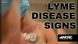 Lyme Disease Marco Island Florida