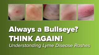 Lyme Disease Rash Indiana Indiana