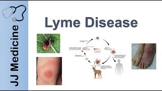 Lyme Disease Rash Paterson New Jersey
